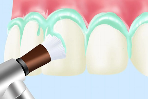 PMTC（Professional Mechanical Tooth Cleaning）